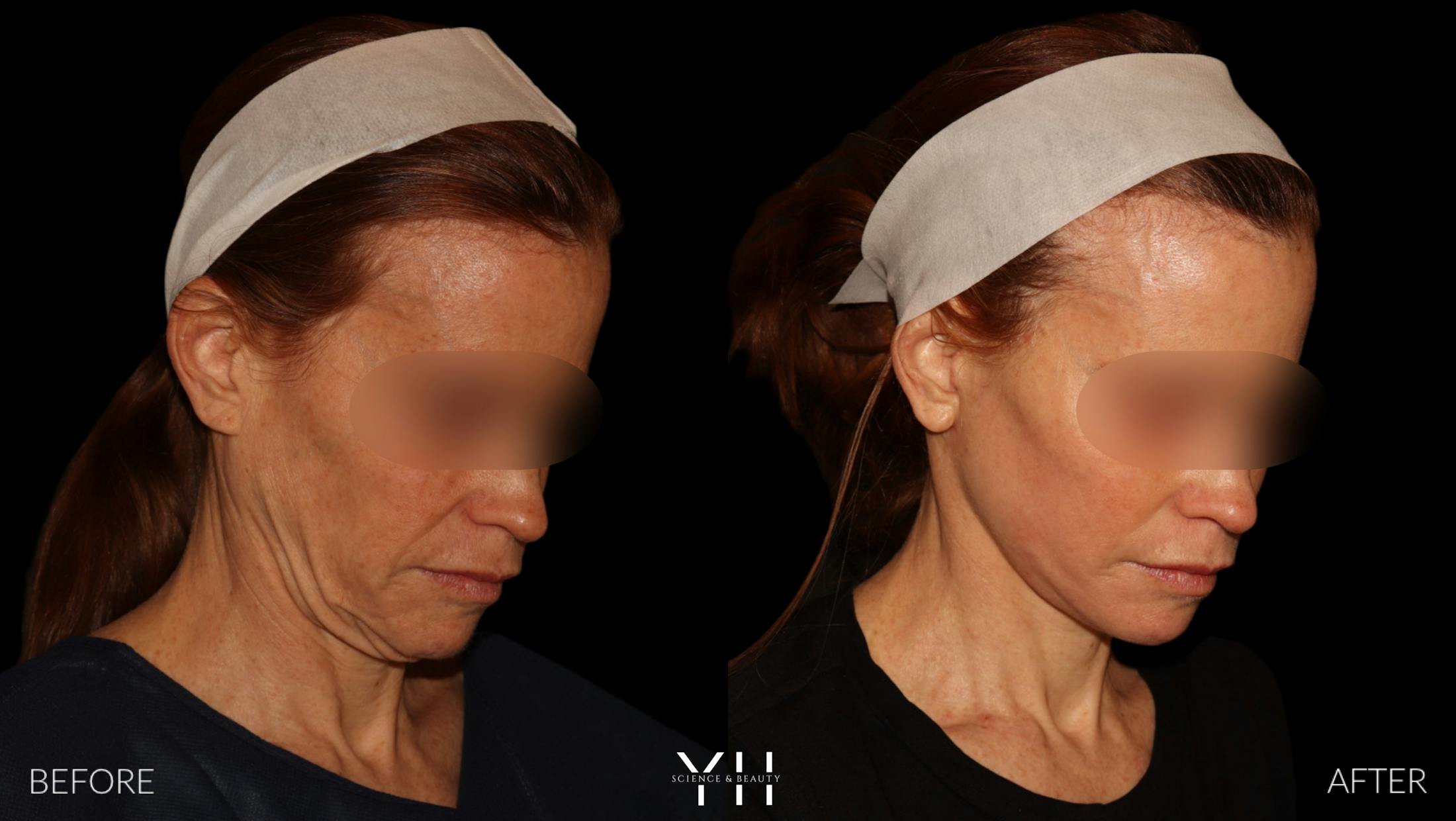 Facelift Before & After Gallery - Patient 117598 - Image 4