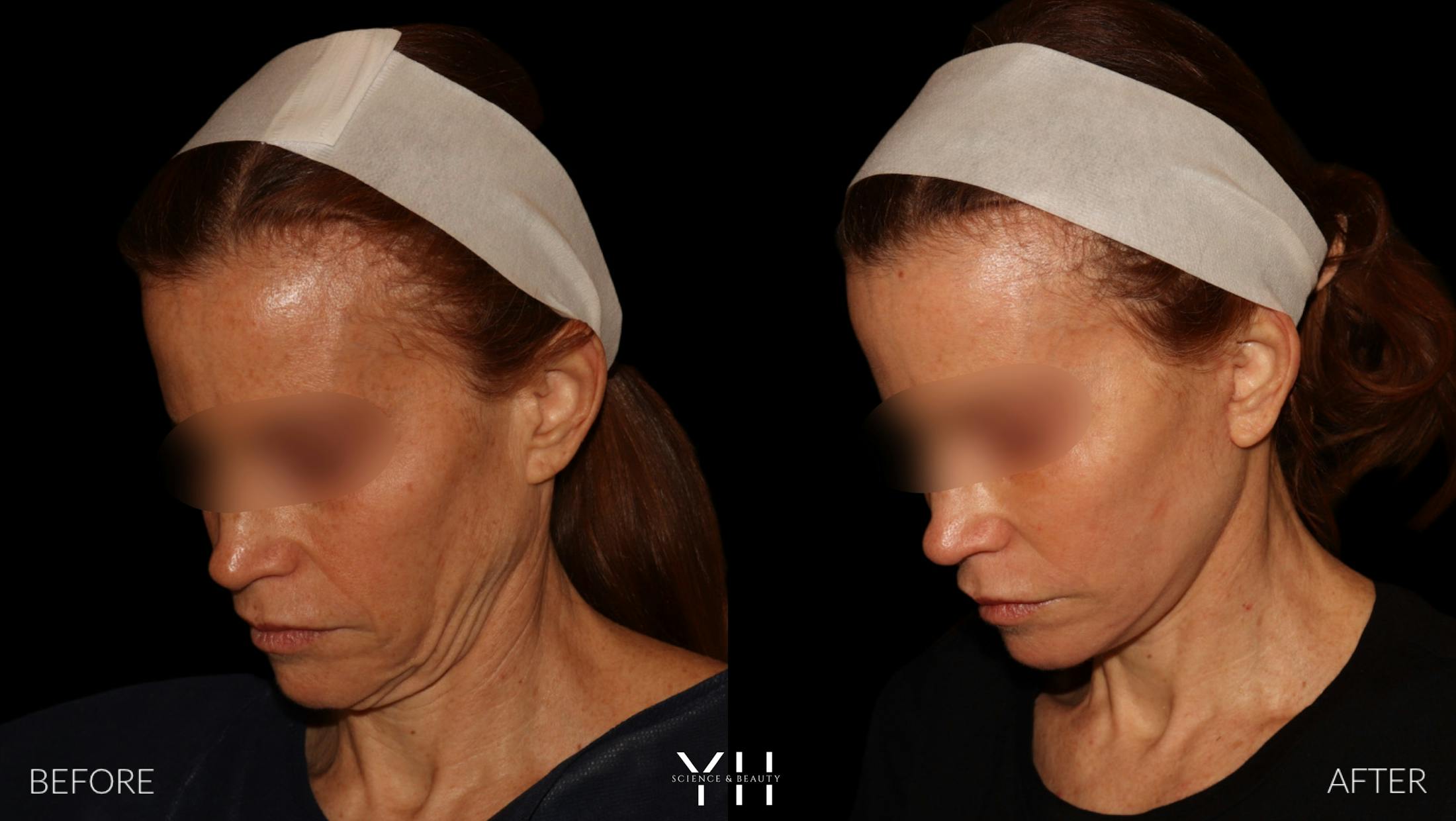 Facelift Before & After Gallery - Patient 117598 - Image 8