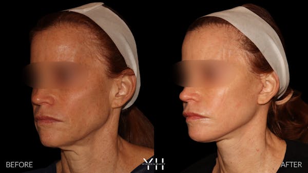 Facelift Before & After Gallery - Patient 117598 - Image 7