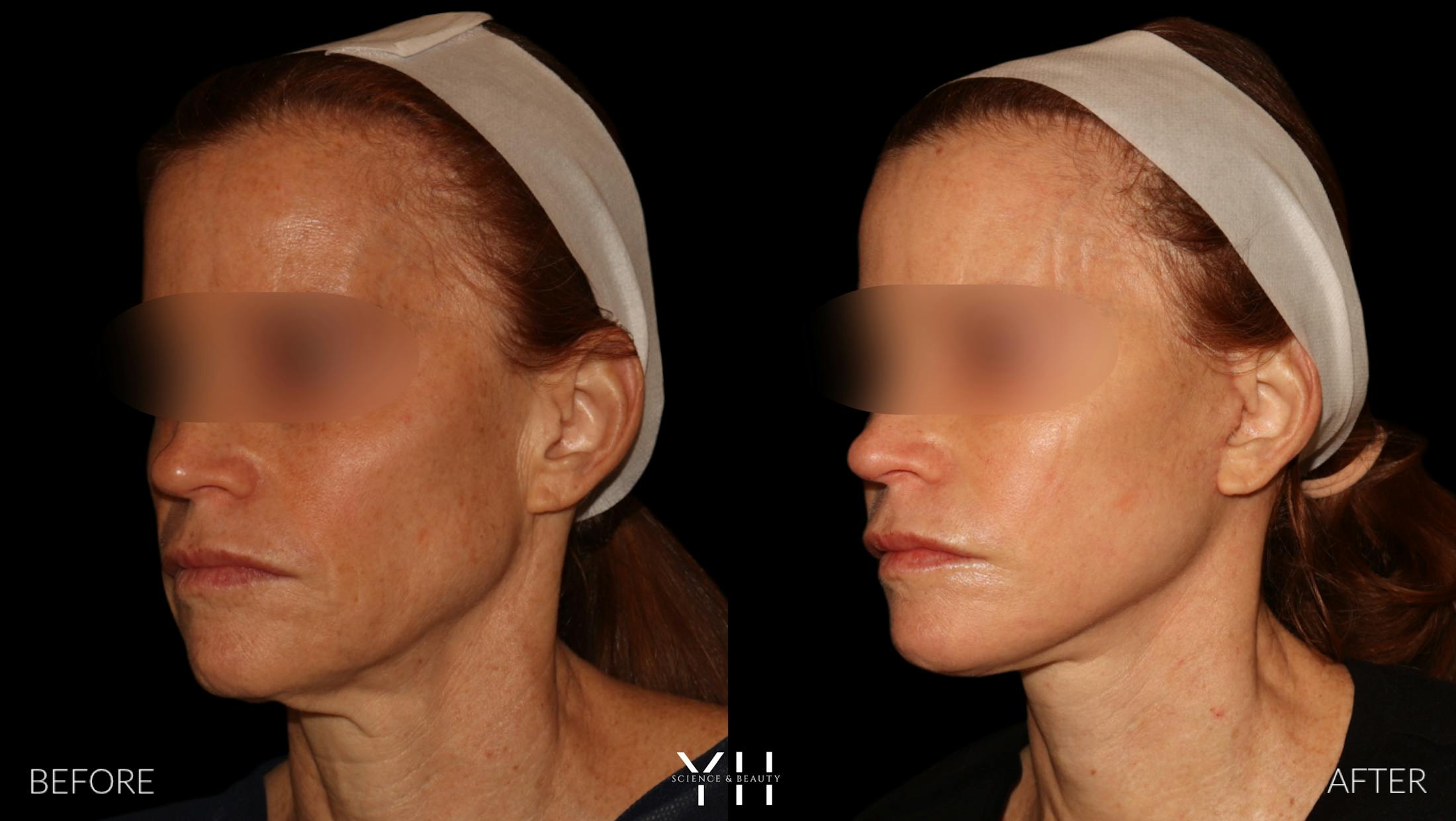 Facelift Before & After Gallery - Patient 117598 - Image 7