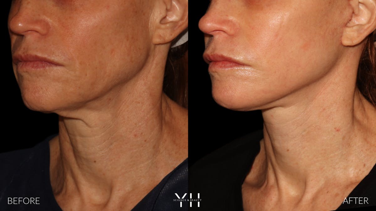 Facelift Before & After Gallery - Patient 117598 - Image 18