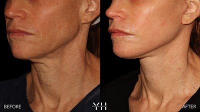 Facelift Before & After Gallery - Patient 117598 - Image 18