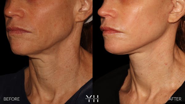 Facelift Before & After Gallery - Patient 117598 - Image 18