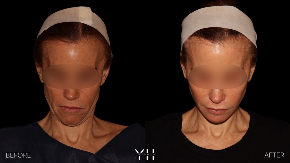 Facelift Before & After Gallery - Patient 117598 - Image 10