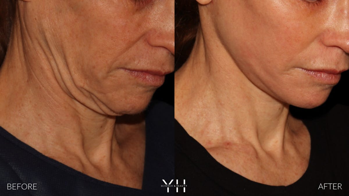 Facelift Before & After Gallery - Patient 117598 - Image 15