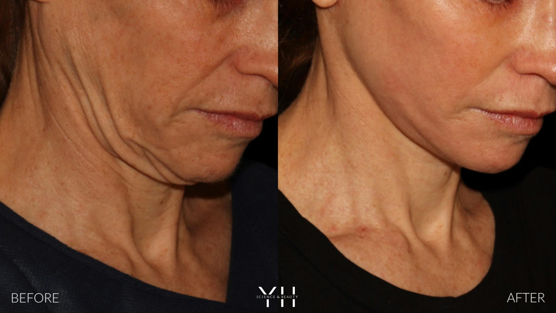 Facelift Before & After Gallery - Patient 117598 - Image 15