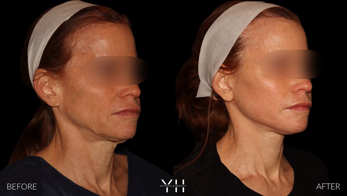 Facelift Before & After Gallery - Patient 117598 - Image 3