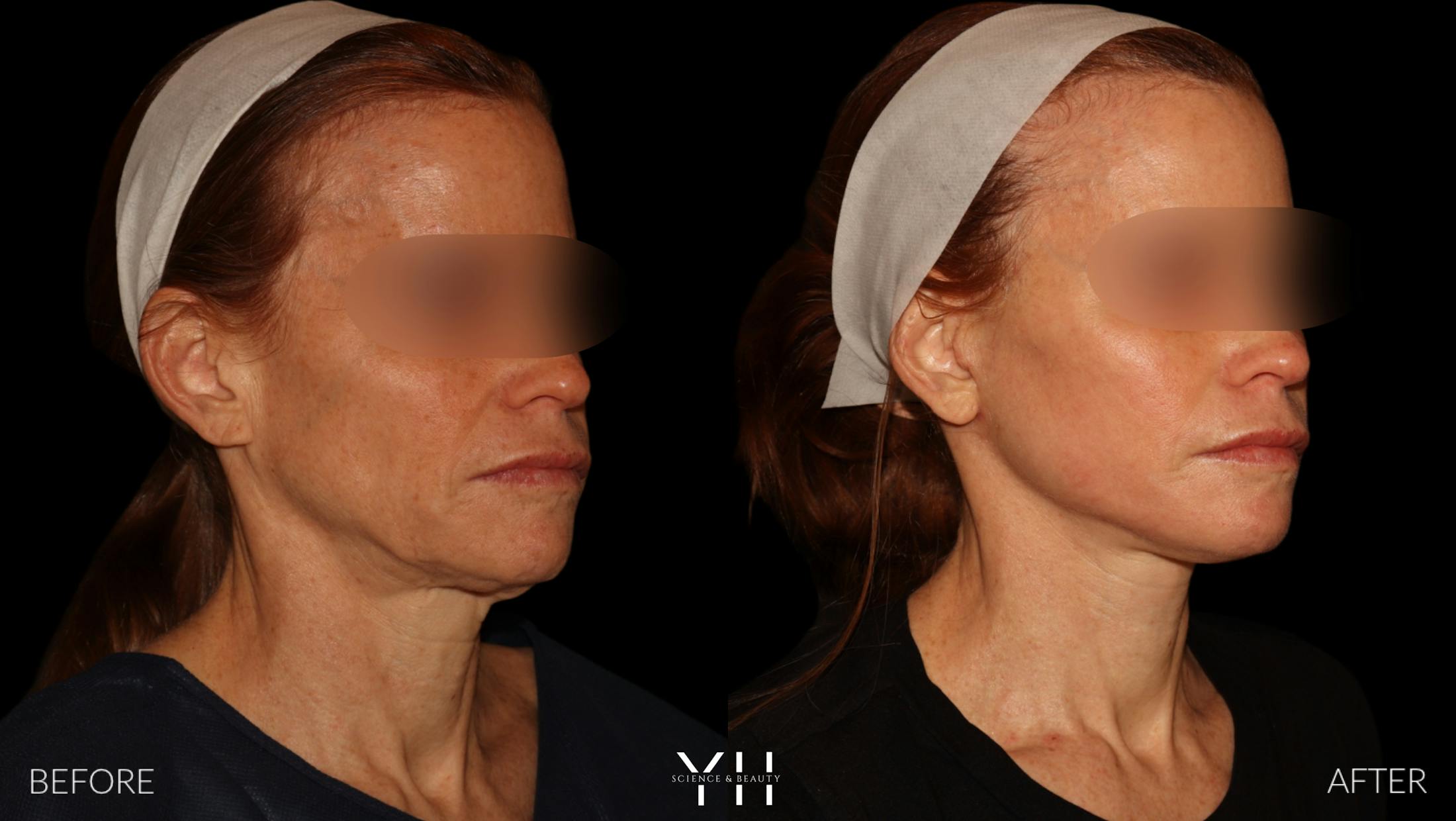 Facelift Before & After Gallery - Patient 117598 - Image 3