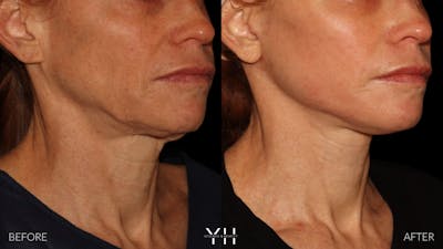 Facelift Before & After Gallery - Patient 117598 - Image 14