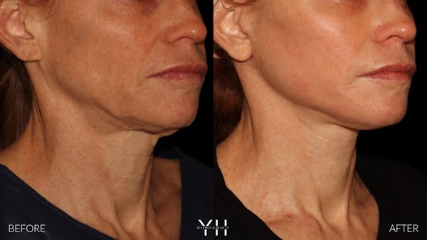 Facelift Before & After Gallery - Patient 117598 - Image 14
