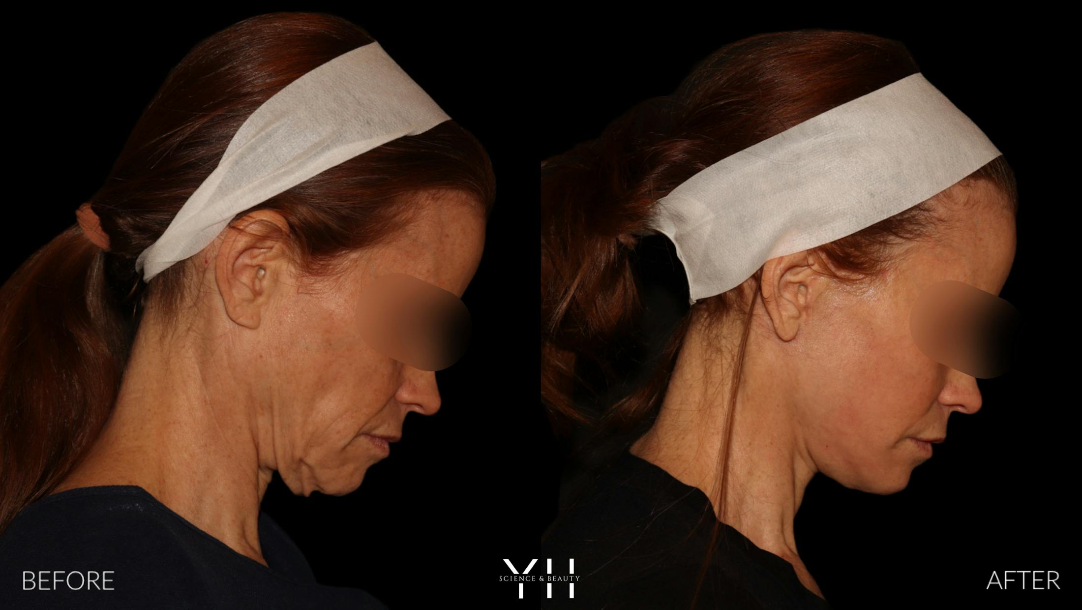 Facelift Before & After Gallery - Patient 117598 - Image 5