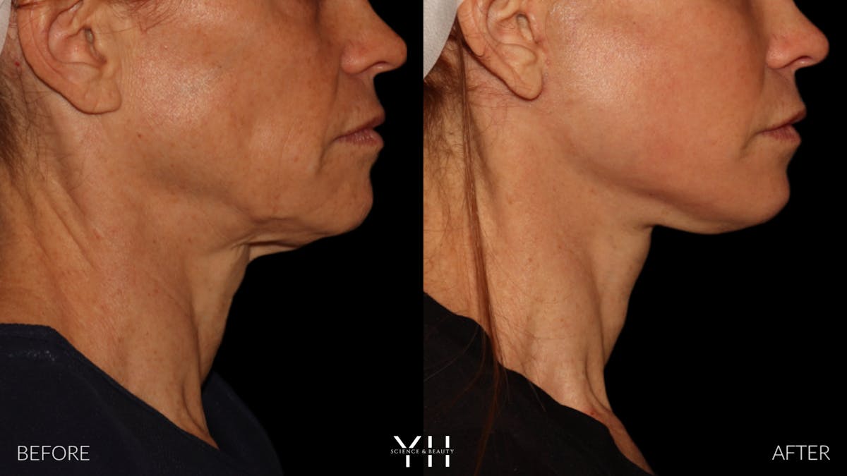 Facelift Before & After Gallery - Patient 117598 - Image 13