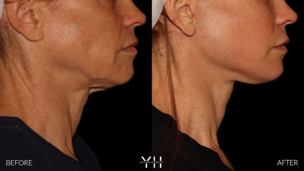Facelift Before & After Gallery - Patient 117598 - Image 13
