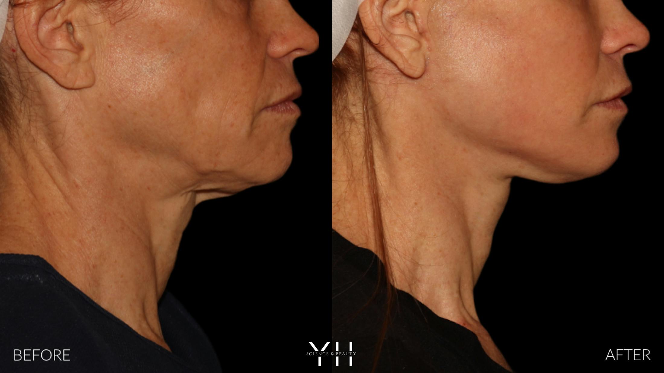 Facelift Before & After Gallery - Patient 117598 - Image 13