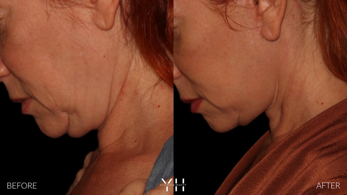 Facelift Before & After Gallery - Patient 100907 - Image 15