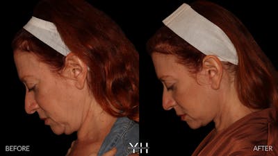 Facelift Before & After Gallery - Patient 100907 - Image 8