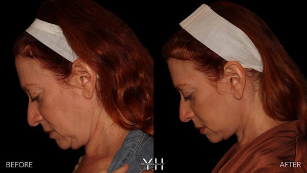 Facelift Before & After Gallery - Patient 100907 - Image 8