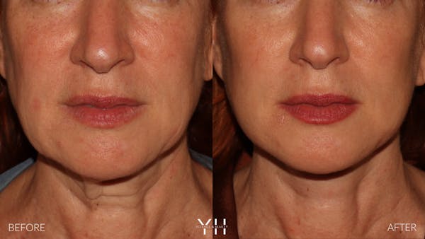 Facelift Before & After Gallery - Patient 100907 - Image 9