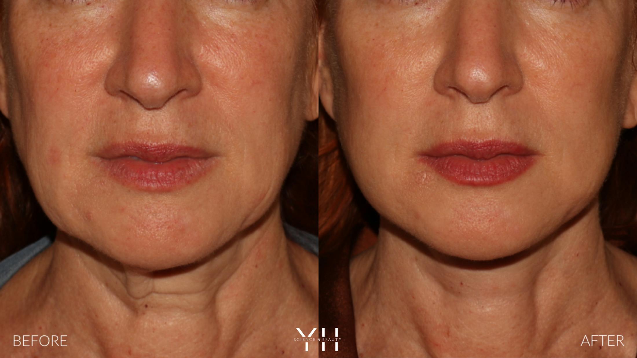 Facelift Before & After Gallery - Patient 100907 - Image 9