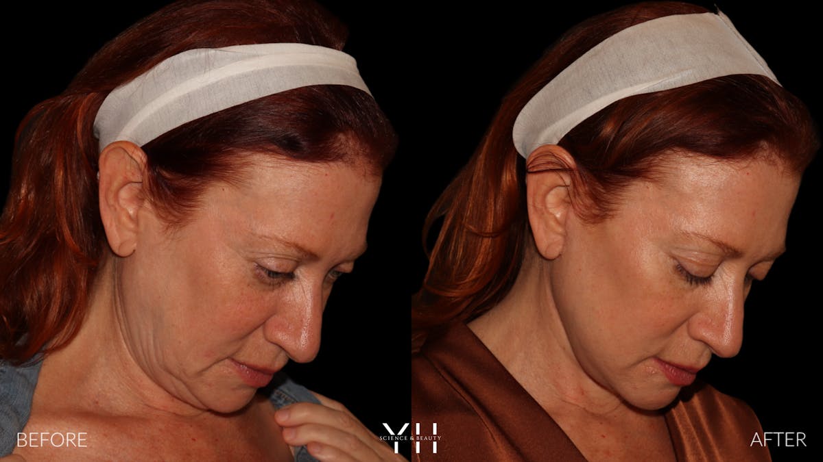 Facelift Before & After Gallery - Patient 100907 - Image 3