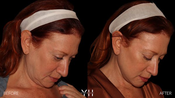 Facelift Before & After Gallery - Patient 100907 - Image 3