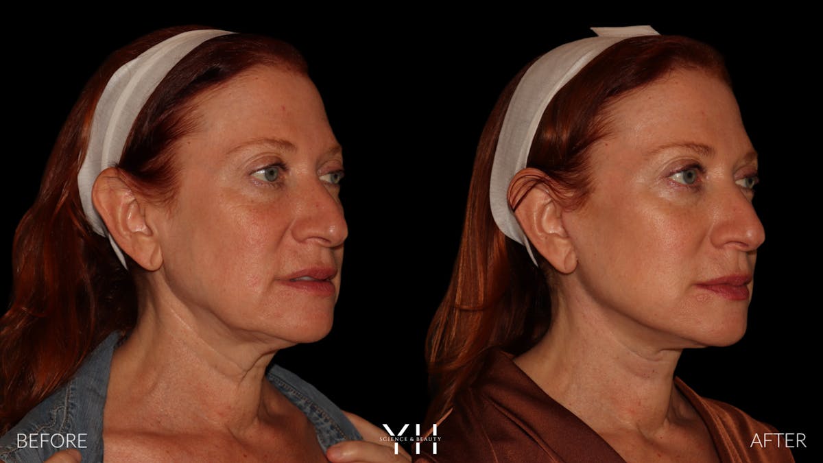 Facelift Before & After Gallery - Patient 100907 - Image 2