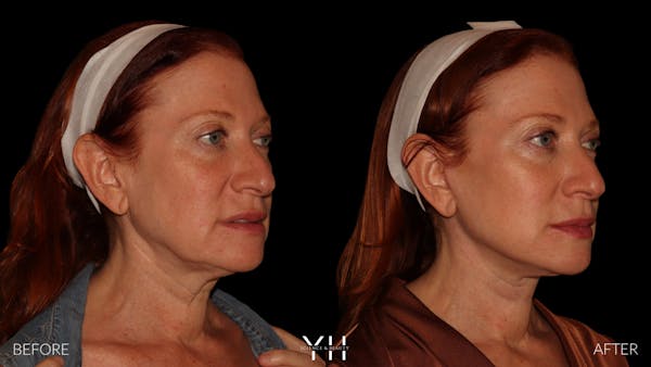 Facelift Before & After Gallery - Patient 100907 - Image 2