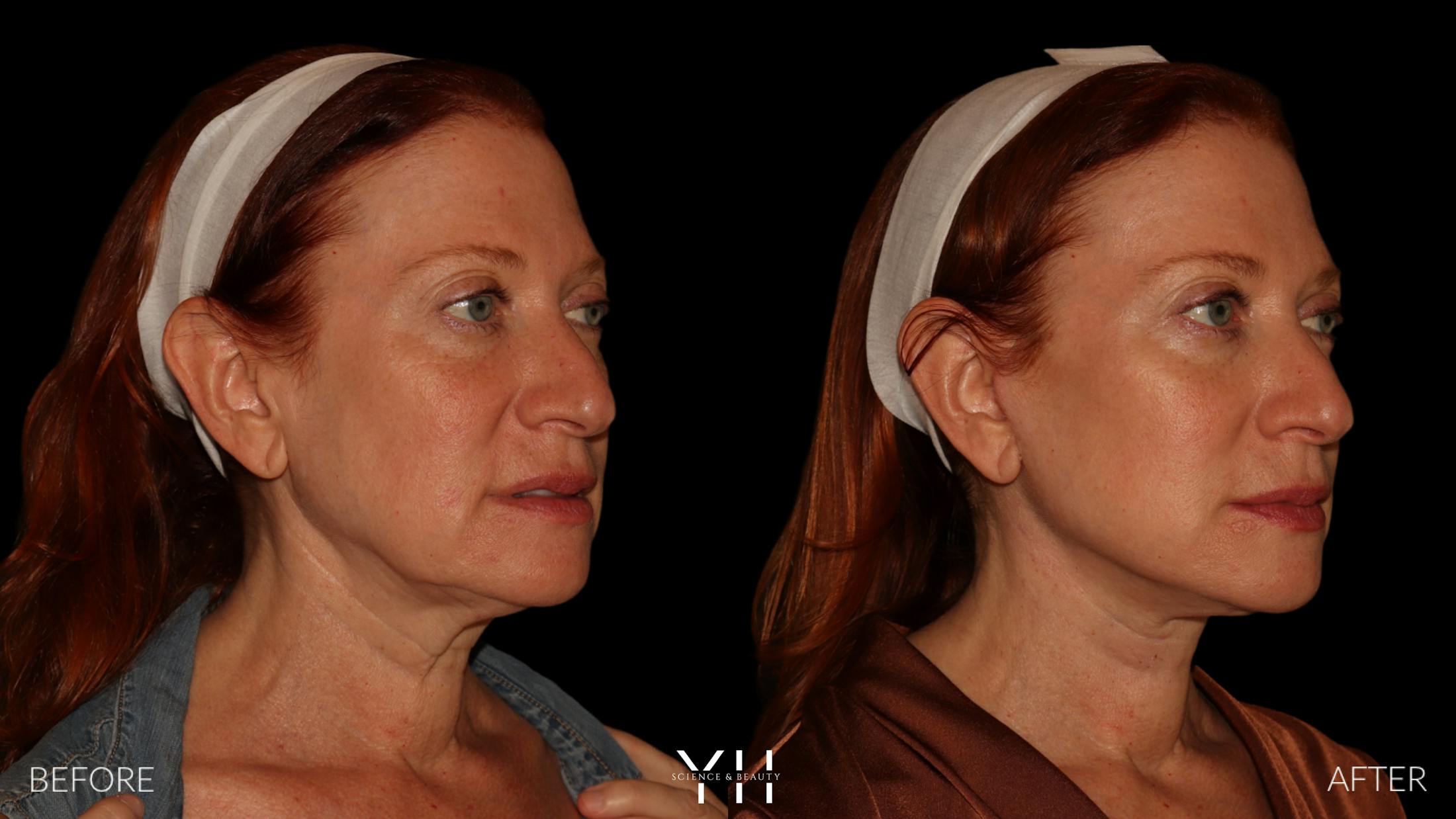 Facelift Before & After Gallery - Patient 100907 - Image 2