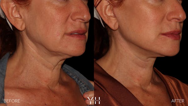 Facelift Before & After Gallery - Patient 100907 - Image 10