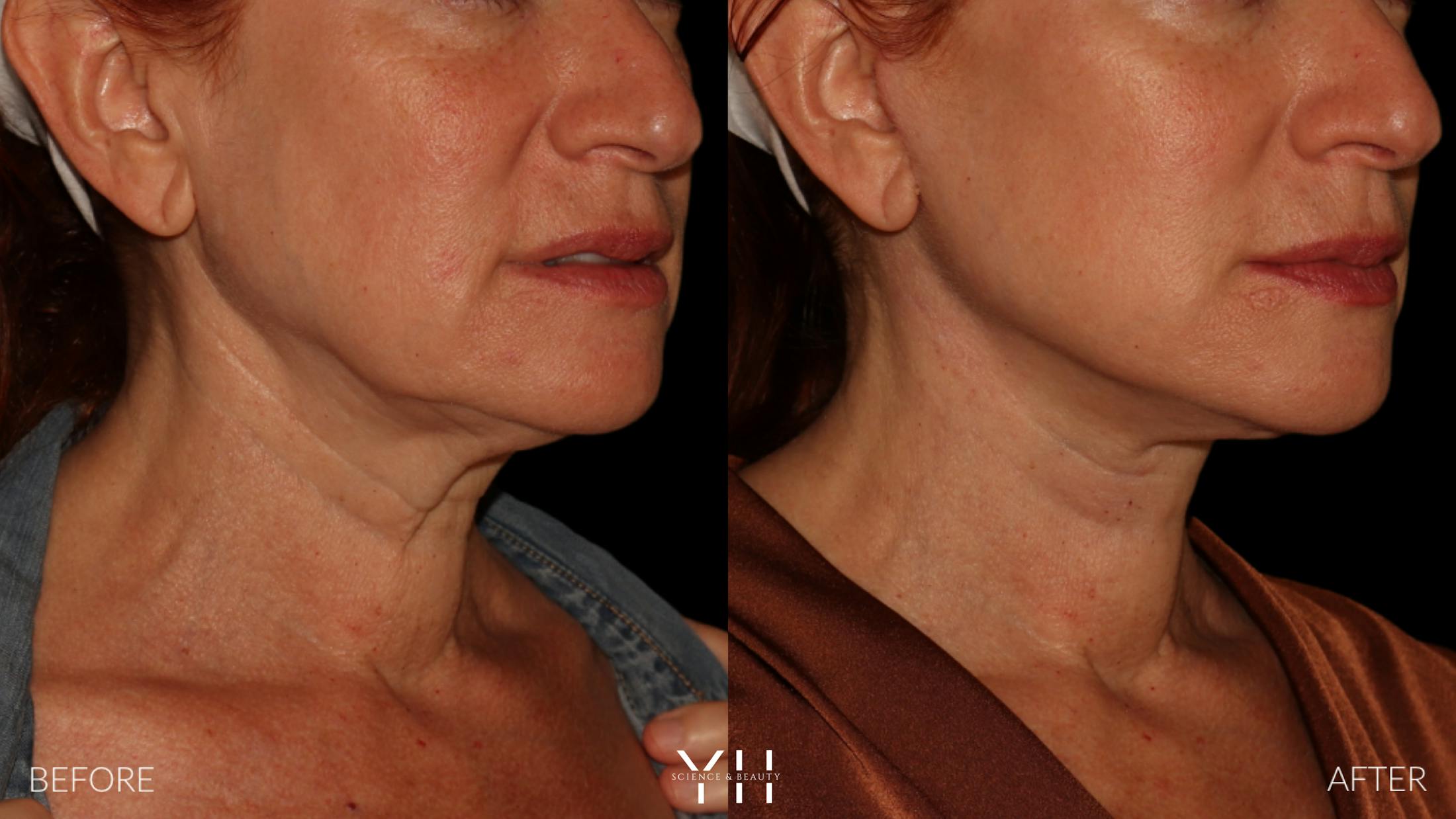 Facelift Before & After Gallery - Patient 100907 - Image 10