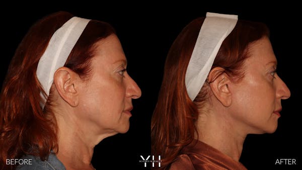 Facelift Before & After Gallery - Patient 100907 - Image 4