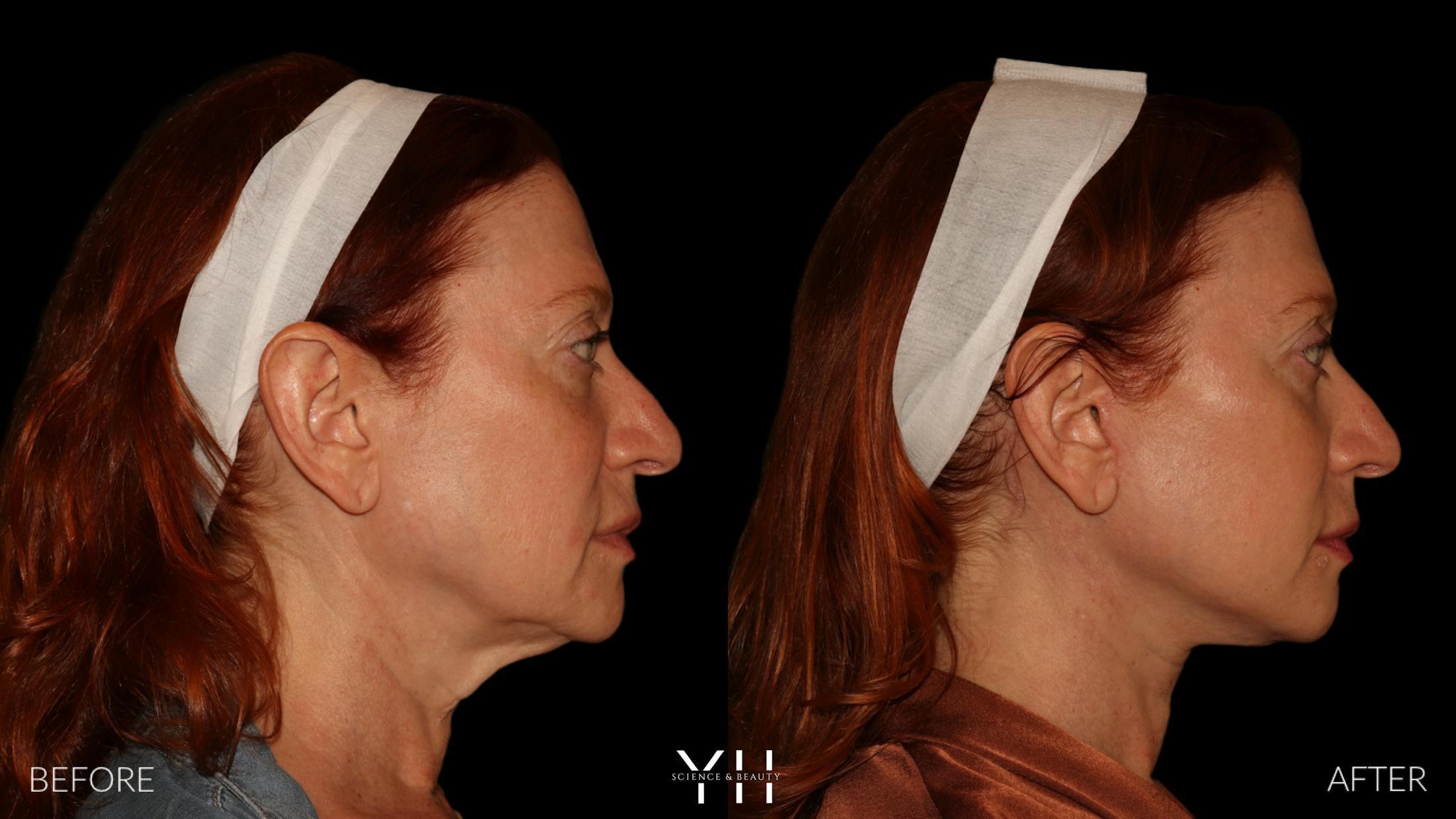 Facelift Before & After Gallery - Patient 100907 - Image 4