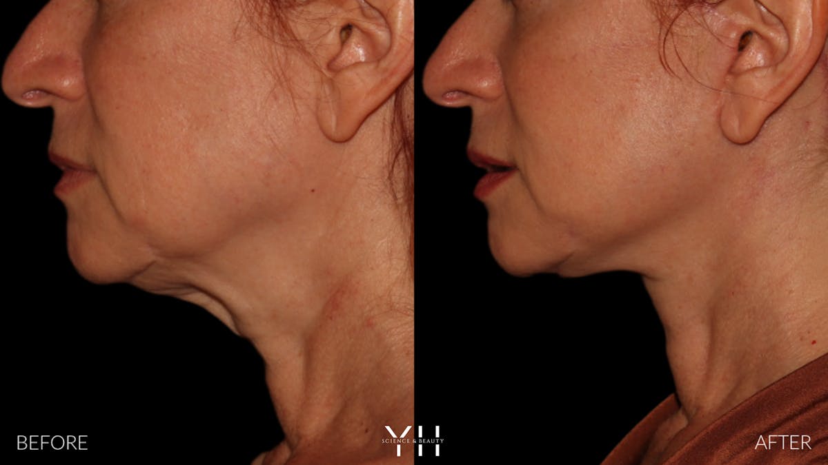 Facelift Before & After Gallery - Patient 100907 - Image 16