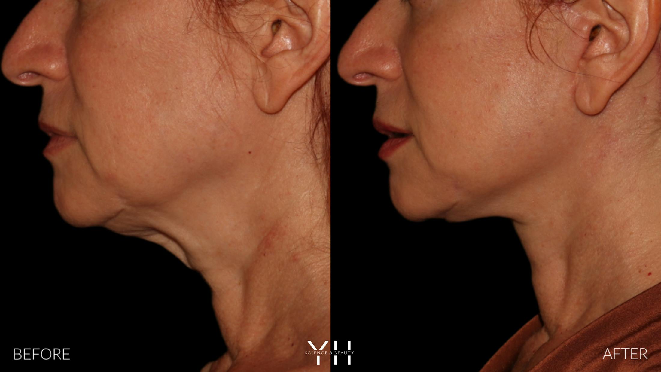 Facelift Before & After Gallery - Patient 100907 - Image 16
