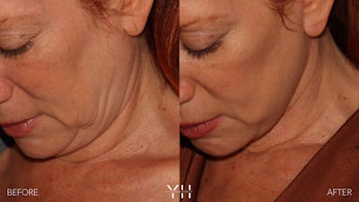 Facelift Before & After Gallery - Patient 100907 - Image 14