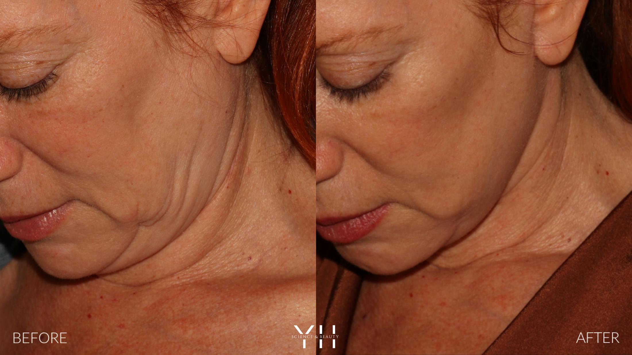 Facelift Before & After Gallery - Patient 100907 - Image 14