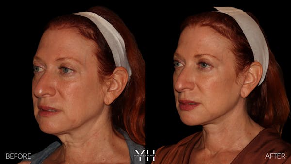 Facelift Before & After Gallery - Patient 100907 - Image 5