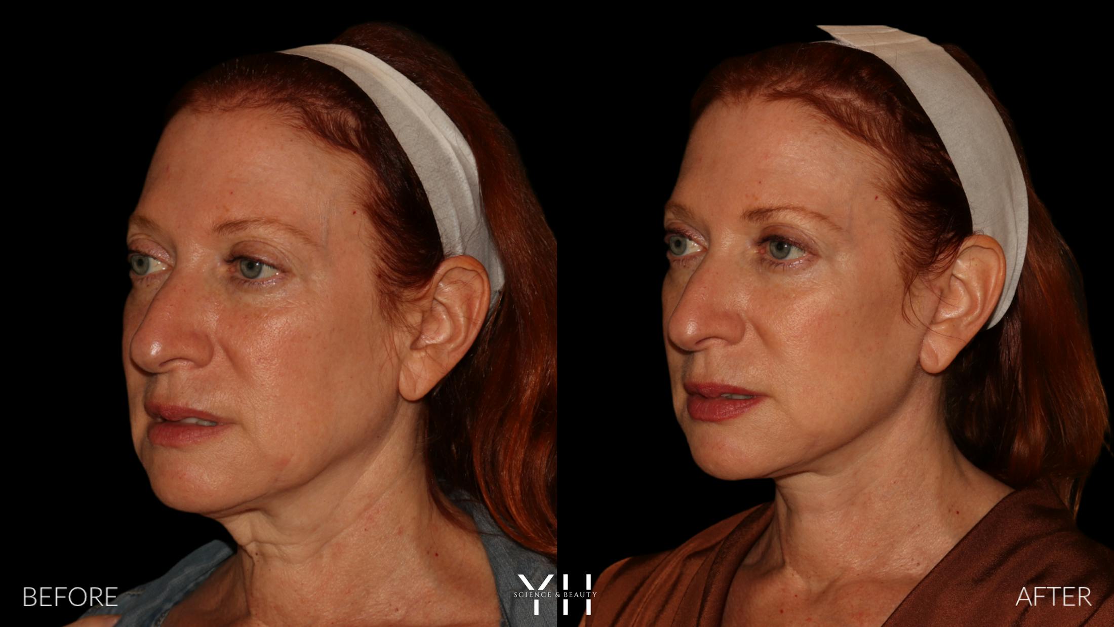 Facelift Before & After Gallery - Patient 100907 - Image 5