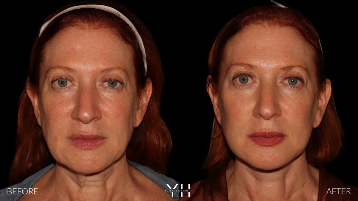 Facelift Before & After Gallery - Patient 100907 - Image 1