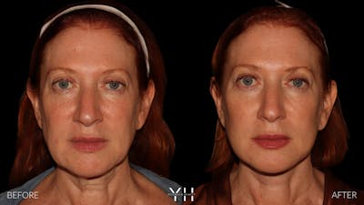 Facelift Before & After Gallery - Patient 100907 - Image 1