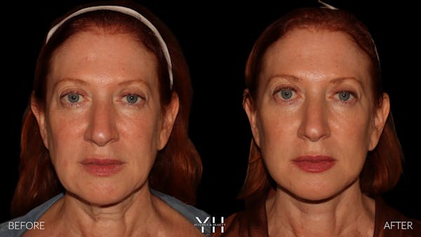 Facelift Before & After Gallery - Patient 100907 - Image 1