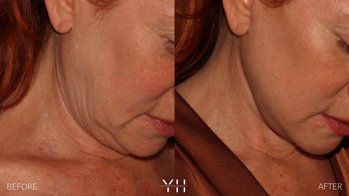 Facelift Before & After Gallery - Patient 100907 - Image 11
