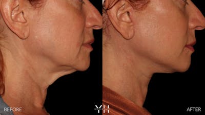 Facelift Before & After Gallery - Patient 100907 - Image 12