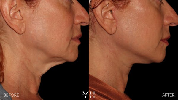 Facelift Before & After Gallery - Patient 100907 - Image 12