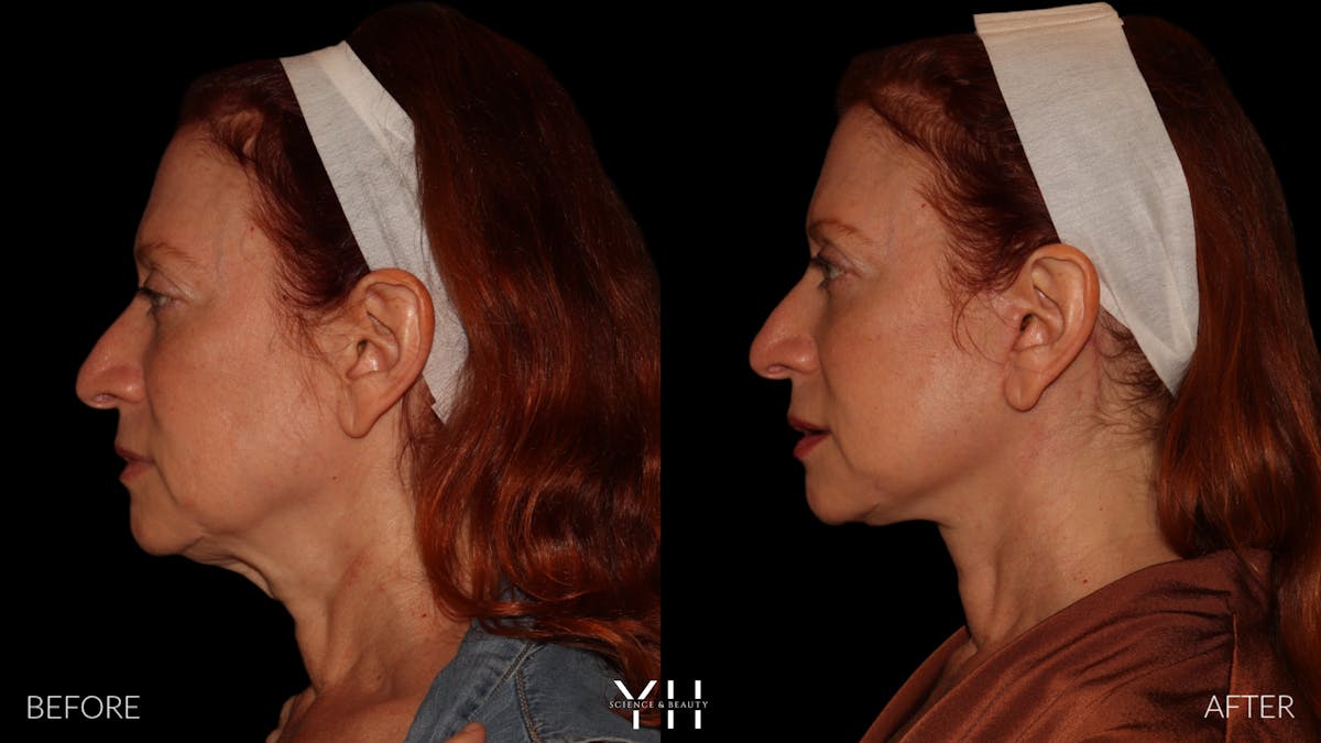 Facelift Before & After Gallery - Patient 100907 - Image 7