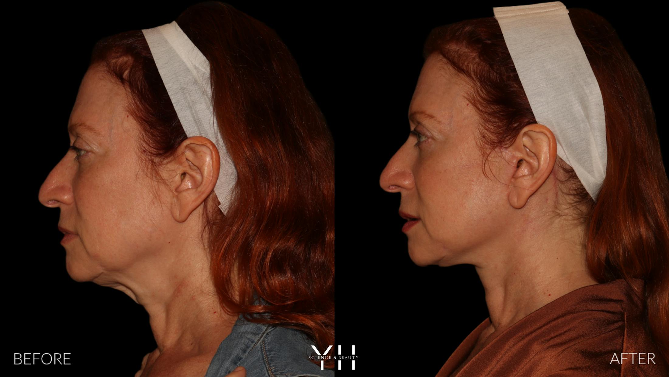 Facelift Before & After Gallery - Patient 100907 - Image 7