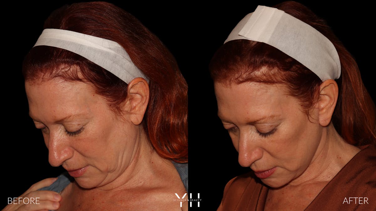 Facelift Before & After Gallery - Patient 100907 - Image 6