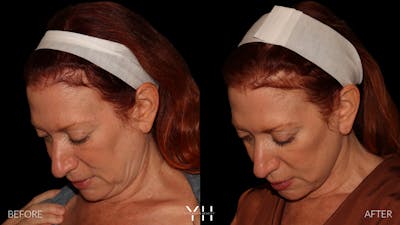 Facelift Before & After Gallery - Patient 100907 - Image 6