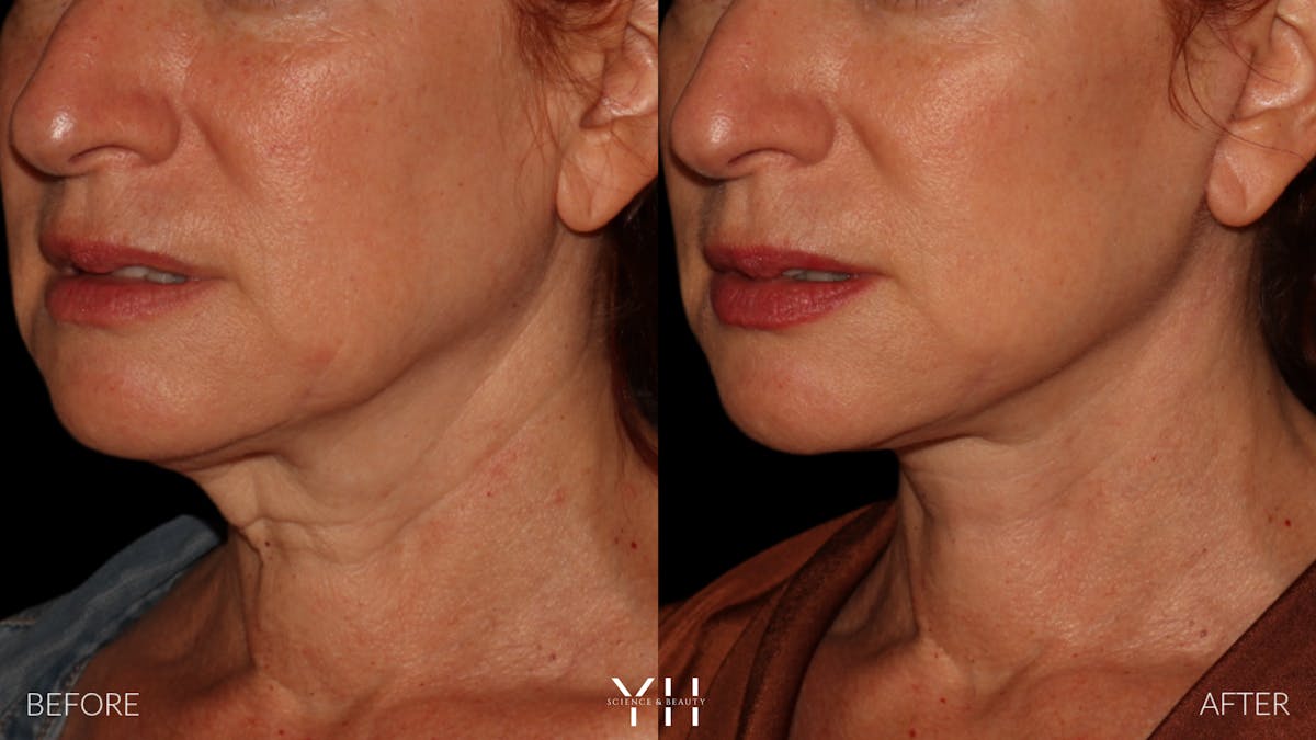 Facelift Before & After Gallery - Patient 100907 - Image 13