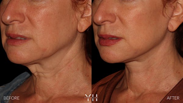 Facelift Before & After Gallery - Patient 100907 - Image 13